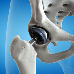 total joint replacement exercises